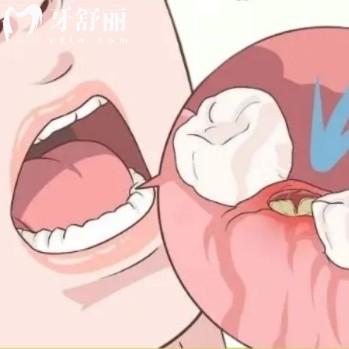 拔牙后的干槽癥有哪些表現(xiàn)？簡單四大癥狀可以自查